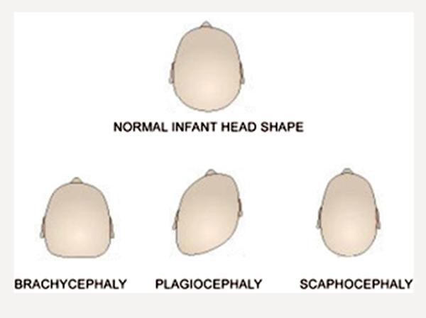 flat head syndrome/Plagiocephaly
