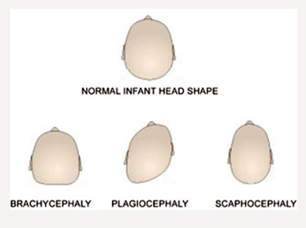 does flat head syndrome affect the brain